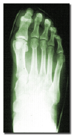 Shoe-fitting History X-Ray